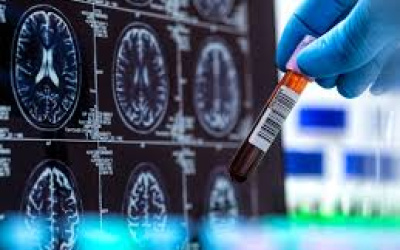 DETAJET PËR TESTIN E PARË TË GJAKUT PËR SËMUNDJEN E ALZHEIMERIT