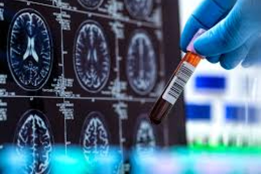 DETAJET PËR TESTIN E PARË TË GJAKUT PËR SËMUNDJEN E ALZHEIMERIT