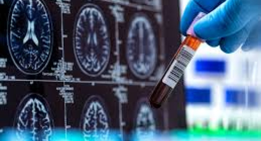 DETAJET PËR TESTIN E PARË TË GJAKUT PËR SËMUNDJEN E ALZHEIMERIT