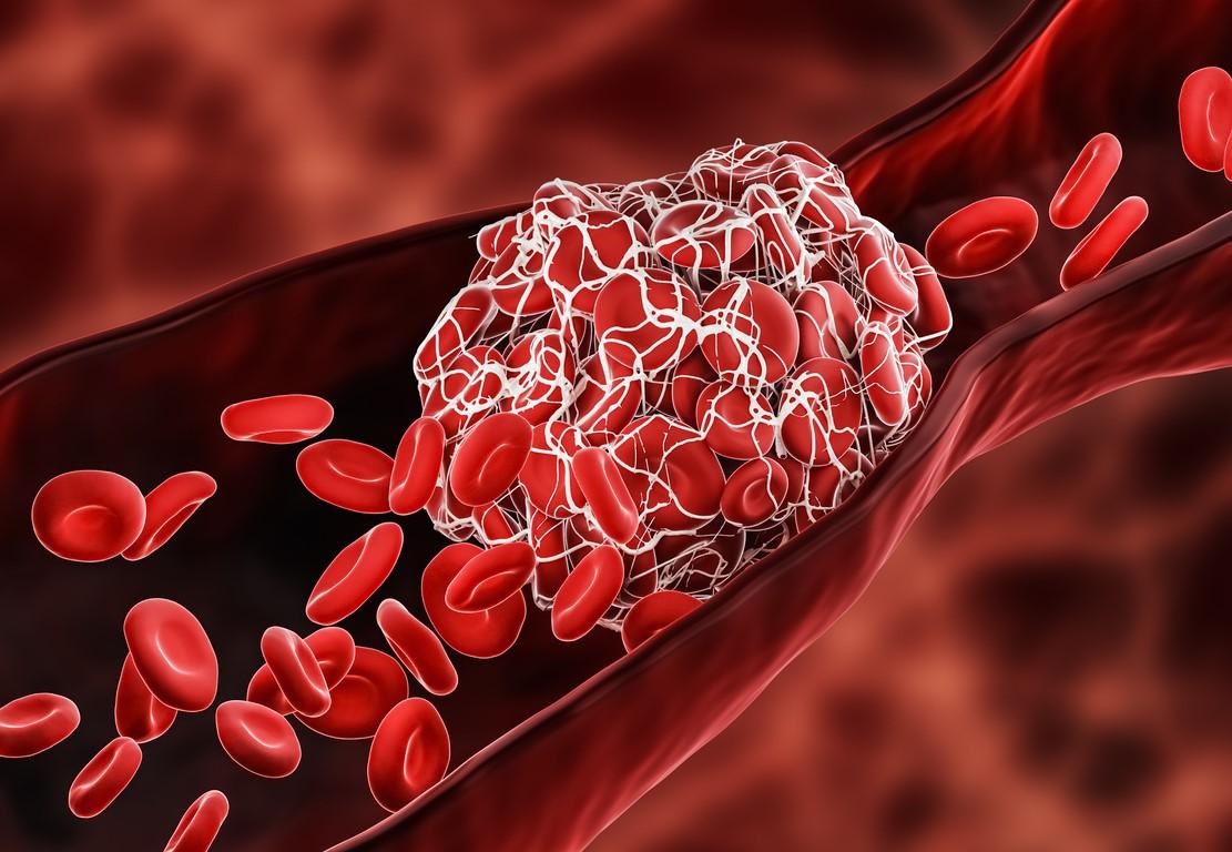 RREZIKU PËR NGJARJE TROMBOEMBOLIKE GJATË PËRDORIMIT TË NJËKOHSHËM TË ANTIKOAGULUESVE DIREKTË ORALË DHE BARNAVE ANTIEPILEPTIKE